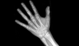 Radiografia da Mão e Punho com análise Carpal e idade Óssea