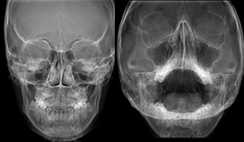 Radiografias dos seios da face (P.A. E WATERS)
