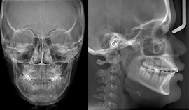 Telerradiografia lateral e frontal