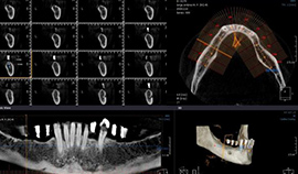 Tomografia computadorizada Cone-Beam para implantes