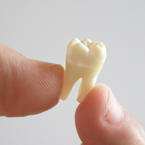 Perda de um dente pode provocar problemas funcionais com perda óssea 