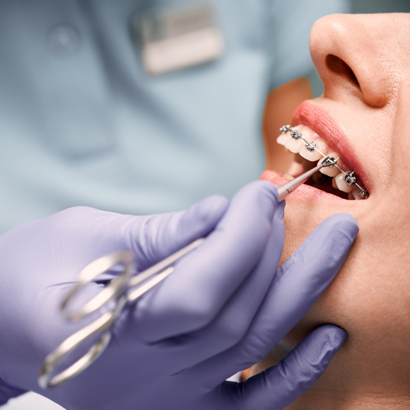 Por quê os dentes ficam moles após manutenção?